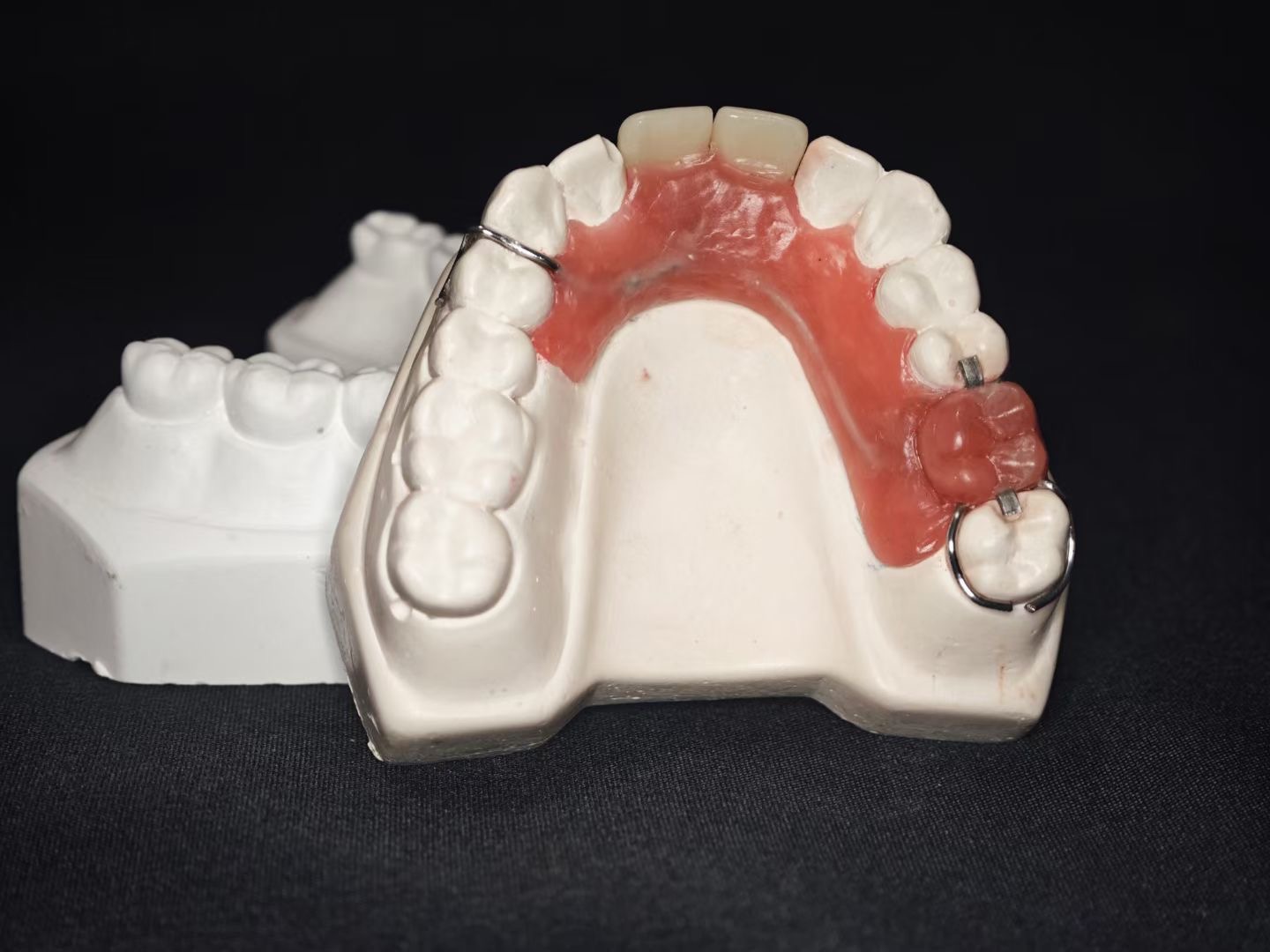First Removable Partial Denture — Lower
