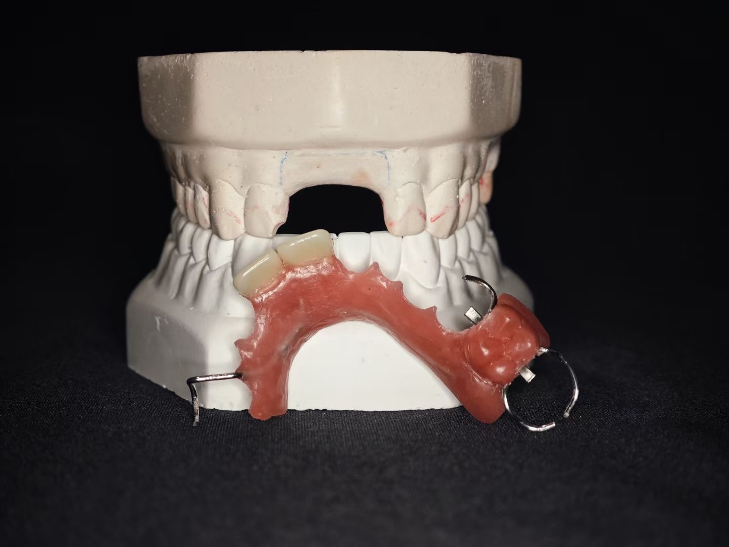 First Removable Partial Denture — Upper